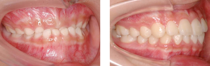 乳歯列骨格性反対咬合を切歯交換期に前歯部被蓋を改善 → 正常歯列に