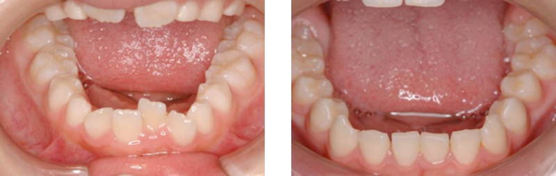 切歯部叢生歯列を切歯交換期に下顎をシュワルツの装置で拡大 → 正常歯列に