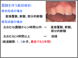 露髄を伴う歯冠破折