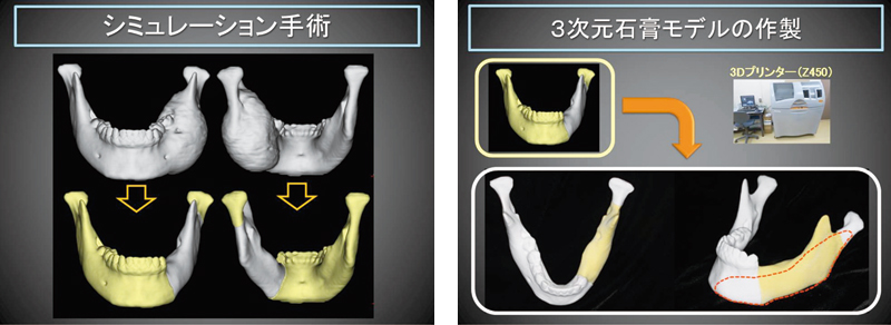 シミュレーション手術、3次元石膏モデルの作成