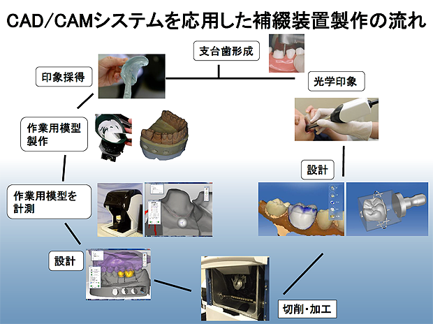 CAD/CAMシステムを応用した補綴装置製作の流れ