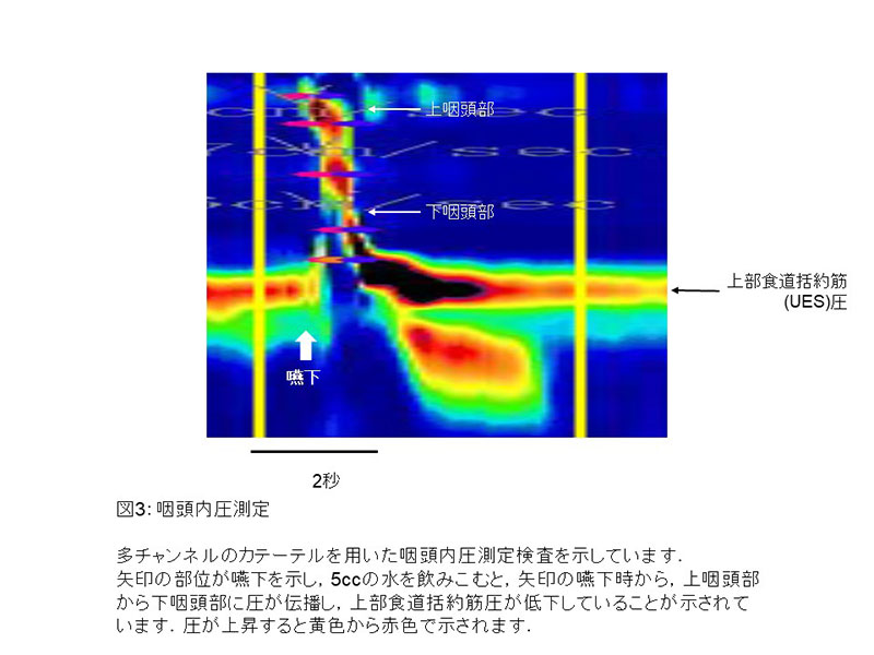 咽頭内圧測定