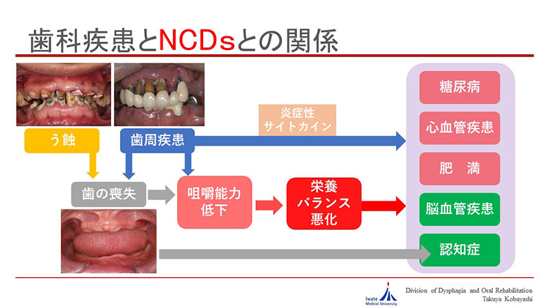 歯科疾患とNCDsとの関係