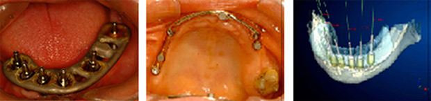 口腔インプラント治療の基礎知識からコンピューターガイドシステムまで
