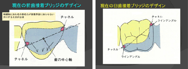 現在の前歯・臼歯接着ブリッジのデザイン