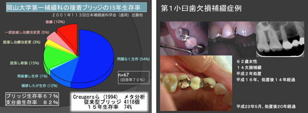 岡山大学第一補綴科の接着ブリッジの15年生存率、第１小臼歯欠損補綴症例