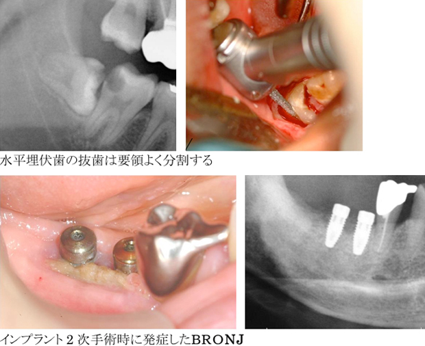 水平埋伏歯の抜歯は要領よく分割する　インプラント２次手術時に発症したBRONJ