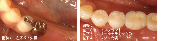 「補綴歯科学の今後の展望」と「今さら聞けないインプラントの基礎知識」