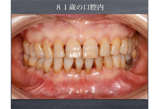 81歳の口腔内