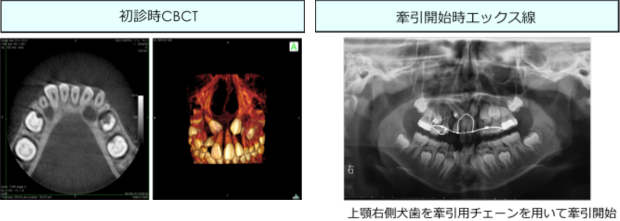 初診時CBCT、牽引開始時エックス線