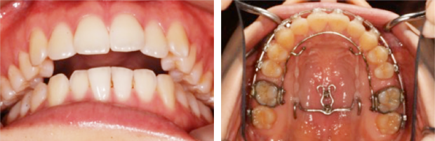 前歯部開咬を示す患者さんの初診時の前歯部被蓋関係、TADを用いた治療とその変化