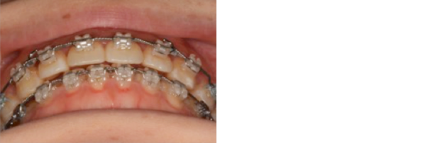 前歯部開咬を示す患者さんの初診時の前歯部被蓋関係、TADを用いた治療とその変化