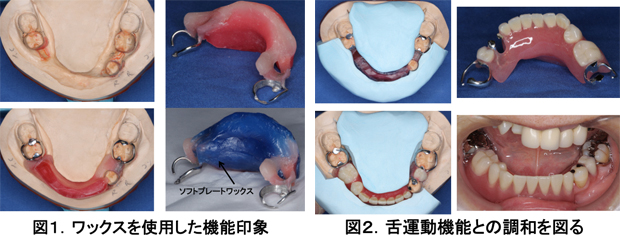 図1.ワックスを使用した機能印象　図2.舌運動機能との調和を図る