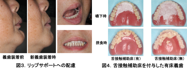 図3.リップサポートへの配慮　図4.舌接触補助床を付与した有床義歯