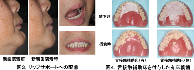 図3.リップサポートへの配慮 図4.舌接触補助床を付与した有床義歯