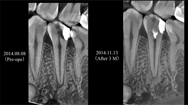 MTAが可能にした歯髄・歯牙保存の最前線