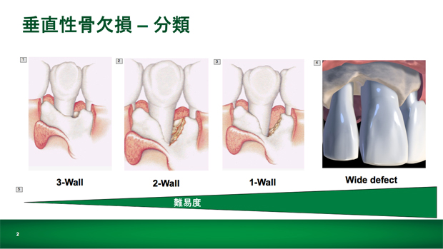 垂直性骨欠損－分類