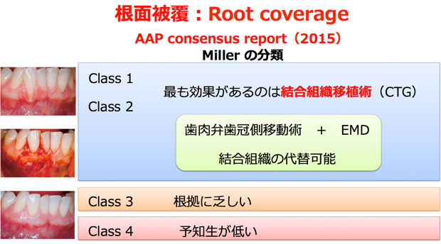 根面被覆：Root coverage