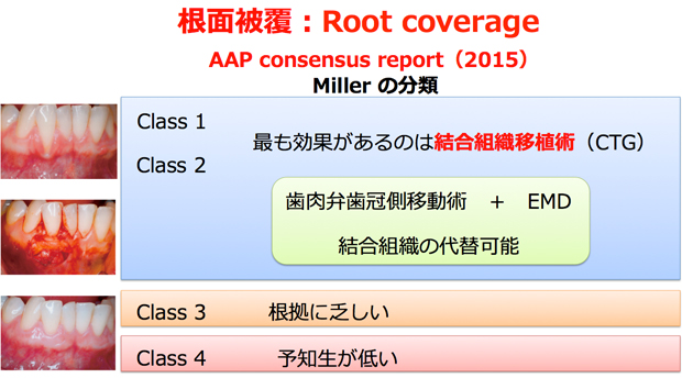 根面被覆:Root coverage