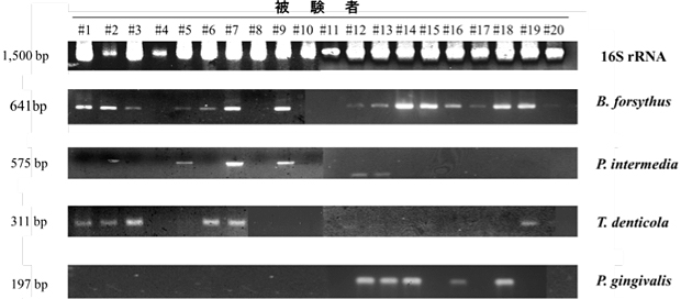 PCR法による舌苔からの歯周病原性細菌の検出結果