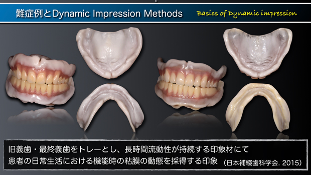 難症例とDynamic Impression Methods