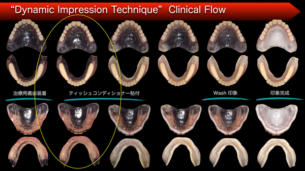 "Dynamic Impression Technique" Clinical Flow