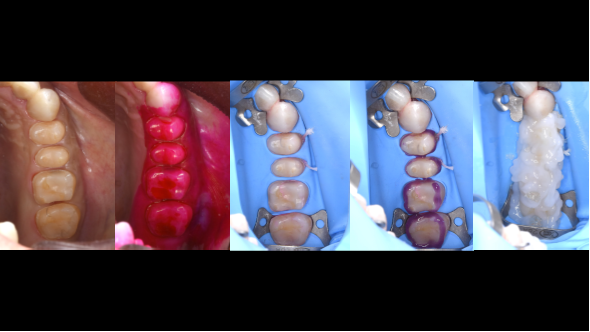 エナメル質及び象牙質の保存