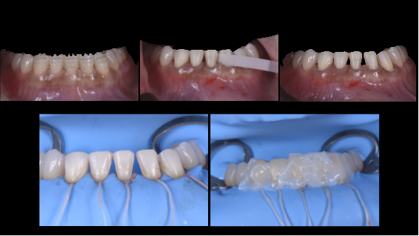 エナメル質及び象牙質の保存
