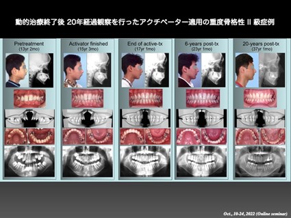 動的治療終了後、20年経過観察を行ったアクチベーター適用の重度骨格性II級症例
