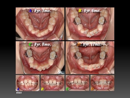 下顎切歯部の叢生を早期に改善する方法と要点
