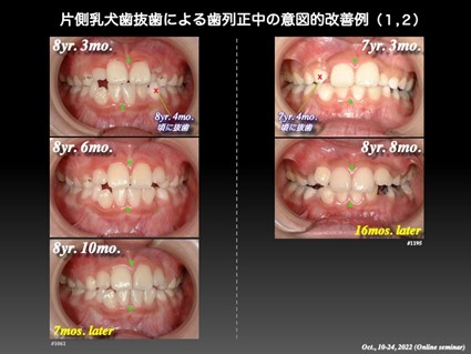 片側乳犬歯抜歯による歯列正中の意図的改善例
