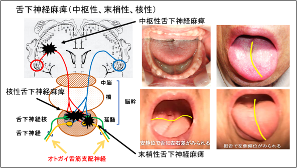 図 ３ 舌下神経麻痺