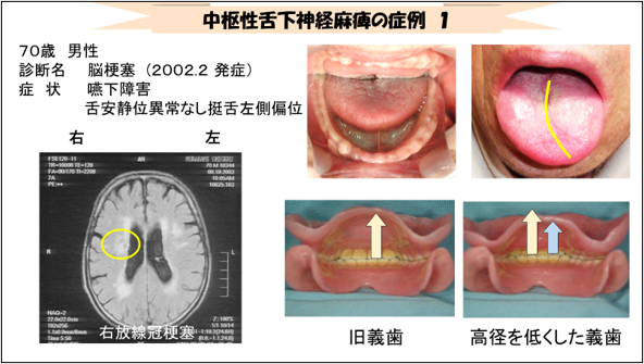 図 4 中枢性舌下神経麻痺