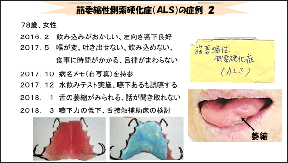 図 １０　ALS症例　２　経過（１）