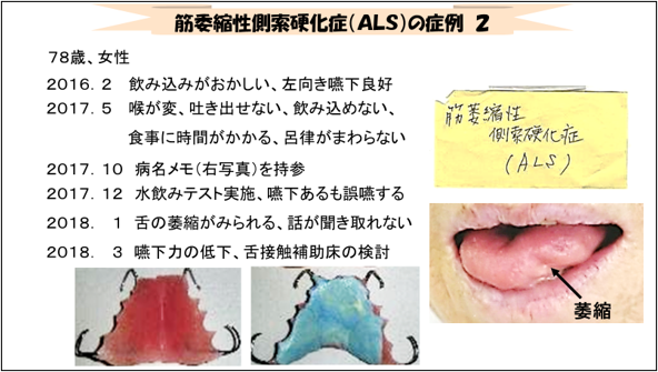 図 10 ALS症例 2 経過(1)