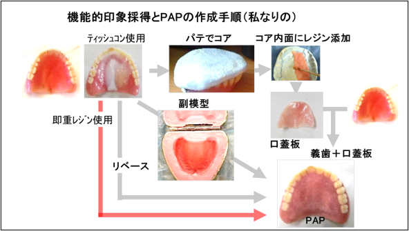 図 12 舌接触補助床の私なりの作り方