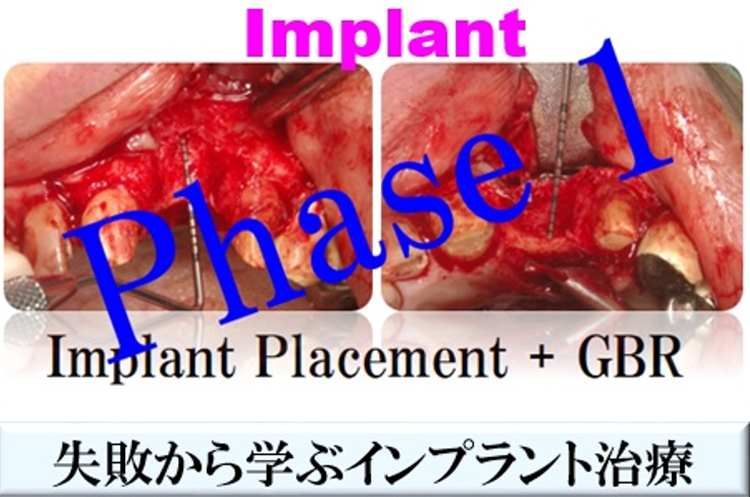 Phase 1　失敗から学ぶインプラント治療