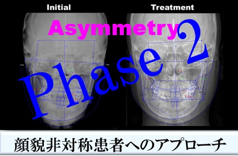Phase 2　顔面非対称患者へのアプローチ