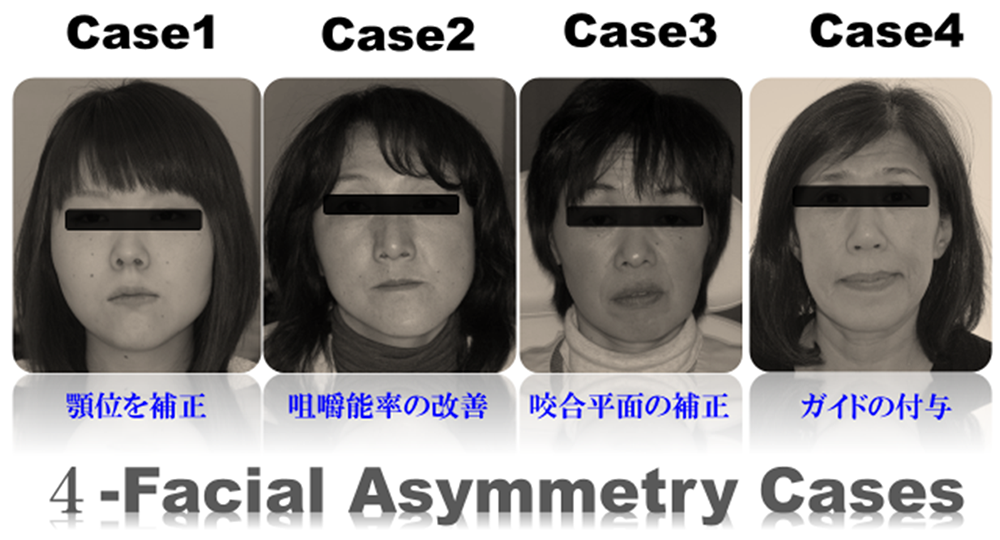 facial asymmetry cases