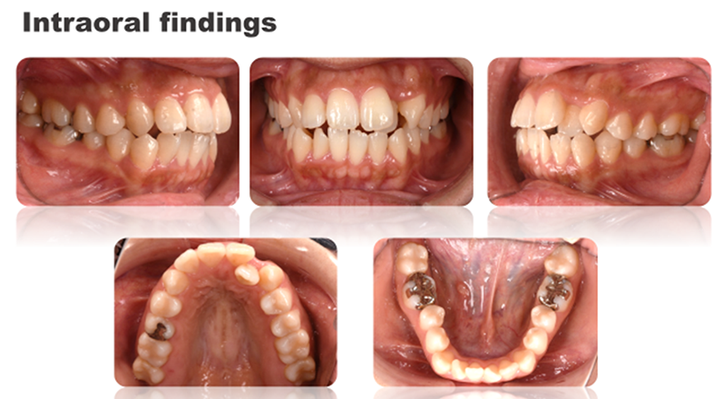 Intraoral findings