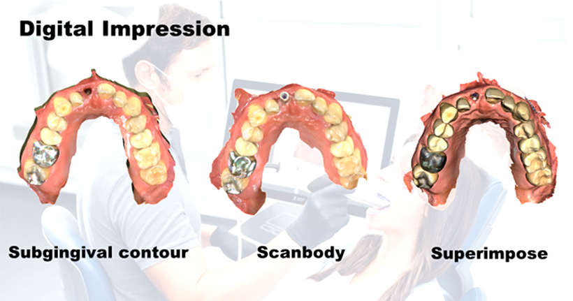 Implant Prosthesis