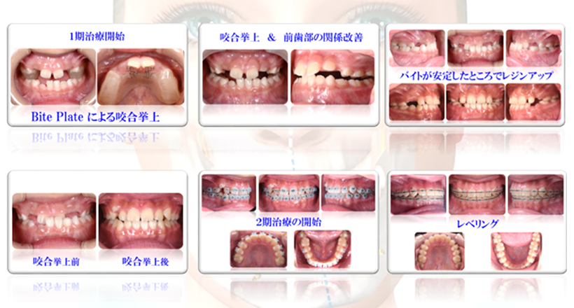 Pre-Orthodontics
