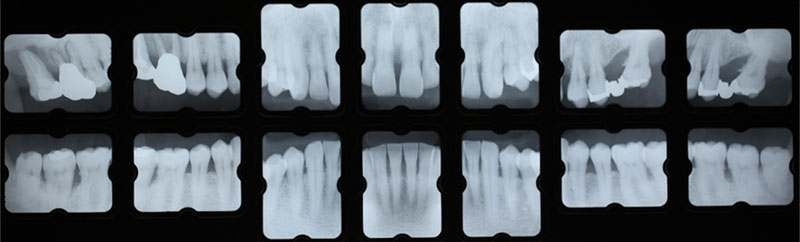 初診時デンタルＸ線写真（図７）