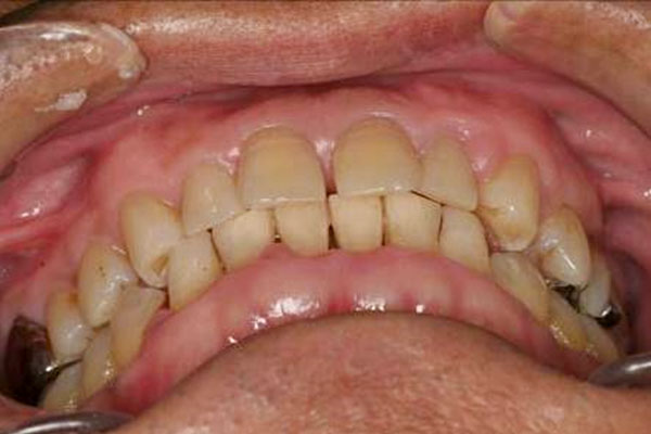 前歯のカップリングの状態（図９）