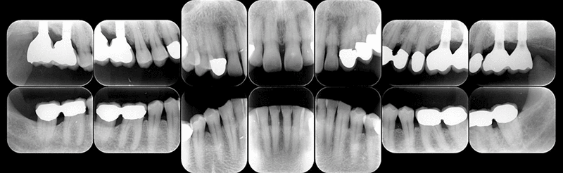 術後14年経過時デンタルX線写真（図42）