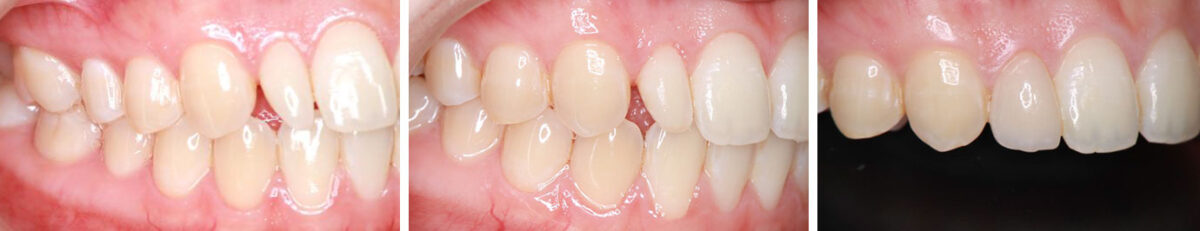 図１ 矮小歯による審美障害に対するラミネートべニア修復 支台歯形成前（左）、支台歯形成後（中央）、ラミネートべニア装着2年後（右）