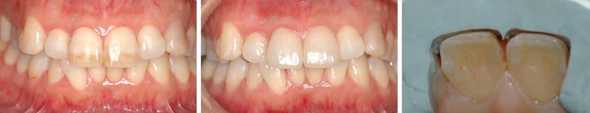 図２ 帯状変色した上顎中切歯に対するラミネートべニア修復 初診時（左）、装着後（中央）、形成時の削除量確認（右）