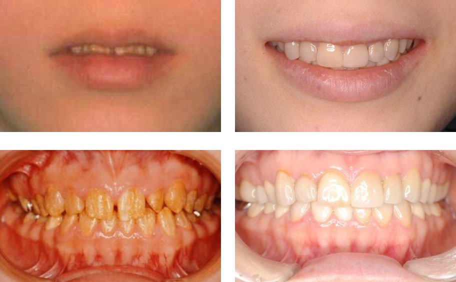 図４ 全顎的なエナメル質形成不全に対するセラミック修復 初診時（上下左）、前歯にはラミネートベニアを、 臼歯にはオールセラミッククラウンを装着（上下右）