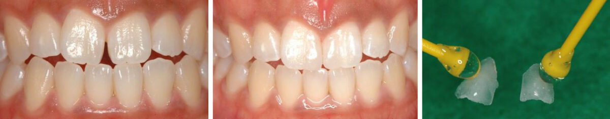 図５ 正中離開にアディショナルべニアを装着 初診時（左）、装着後（中央）、装着したラミネートシェル