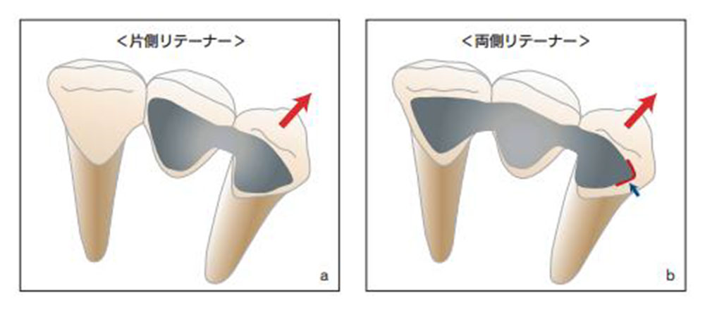 図６設計の違いによるリテーナーの挙動（文献４より引用） 片側リテーナーでは側方荷重時に歯とブリッジが一体として動くのに対し、両側リテーナーでは剥離する力となる。